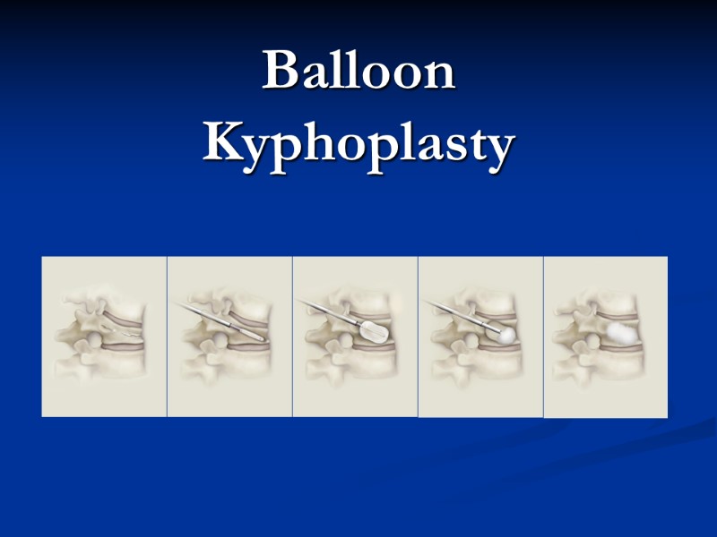 Balloon  Kyphoplasty